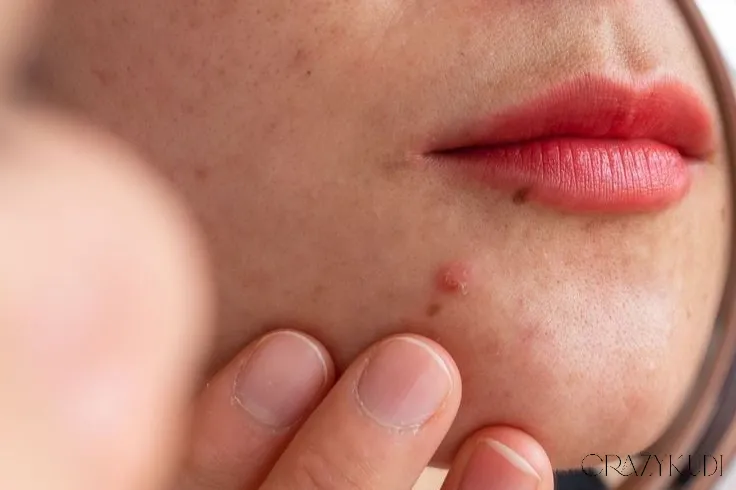5 Foods That Secretly Trigger Pimples and Oily Skin – Dermatologist Insights