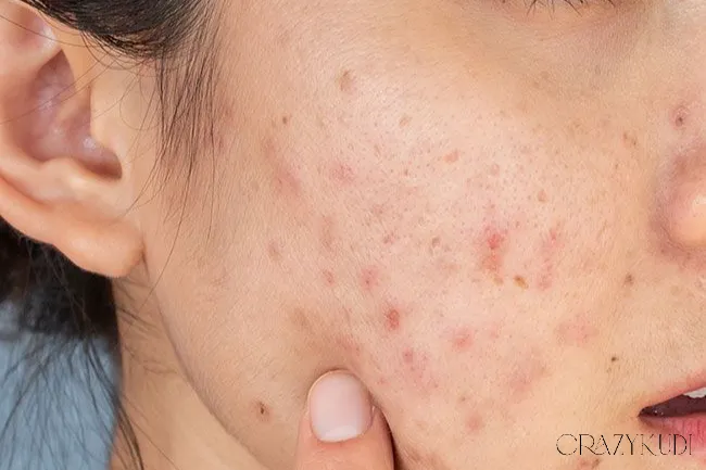 Actives and Acids for Hyperpigmentation: How to Fade Dark Spots Effectively