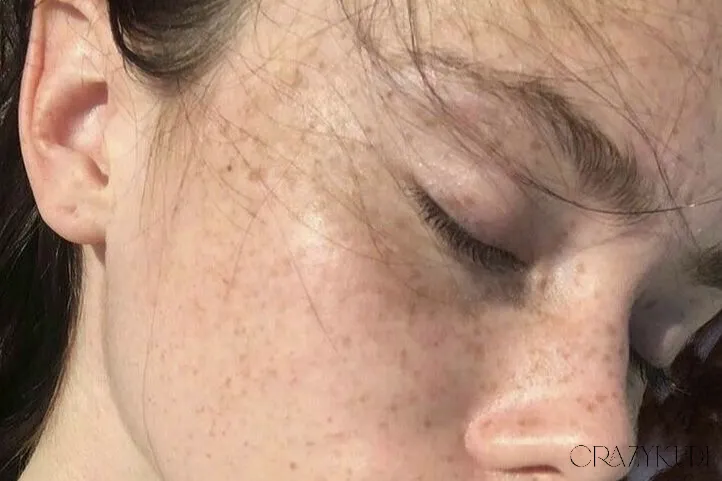 Effective Treatments and Solutions for Pimples: Clear Skin Tips