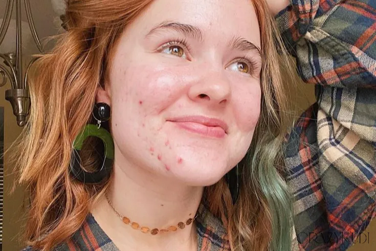 Comprehensive Acne Guide: Understanding Different Types of Acne and How to Effectively Prevent Them