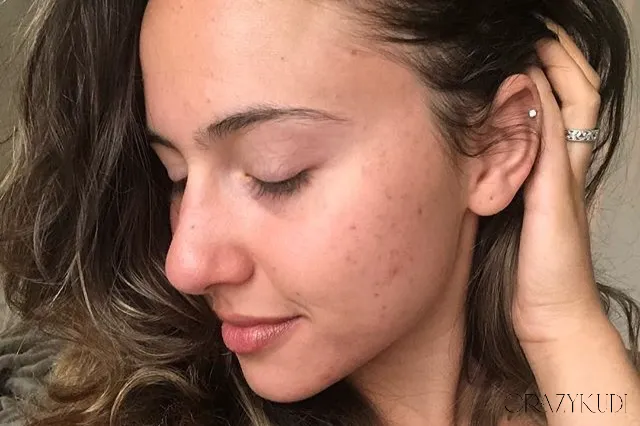 The Powerful Benefits of Niacinamide for Acne-Prone Skin: A Dermatologist’s Guide