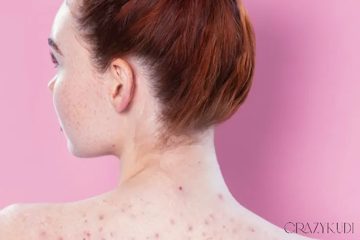 Acne Mechanica: What It Is and How to Treat It Effectively