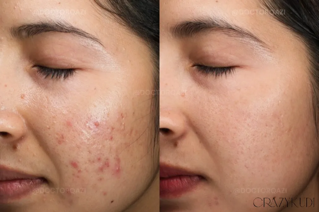 10 Pain Relief Tips for Nodular Acne