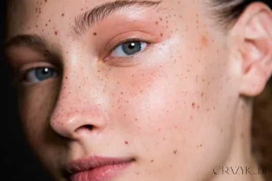 What Is Nodular Acne and How Is It Treated?