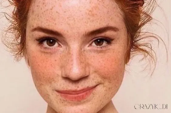 Tazorac and Its Use for Treating Acne: What You Need to Know