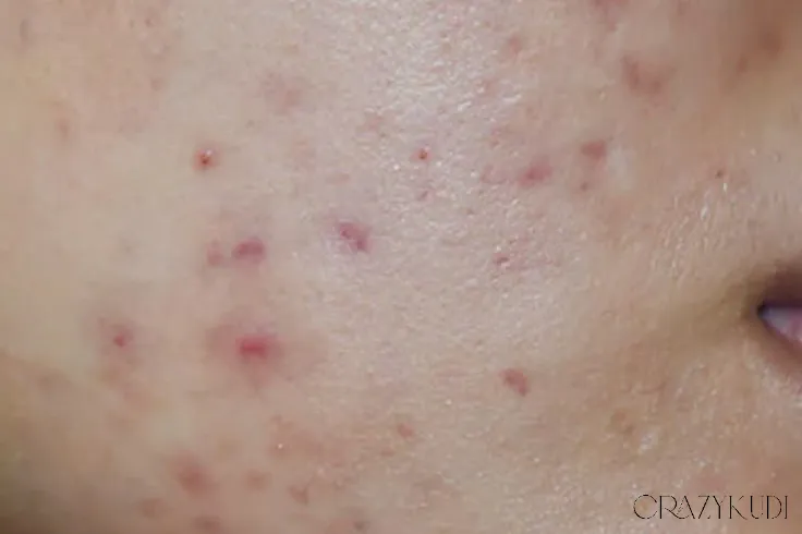 Is Light Therapy for Acne the Treatment You’ve Been Looking For?