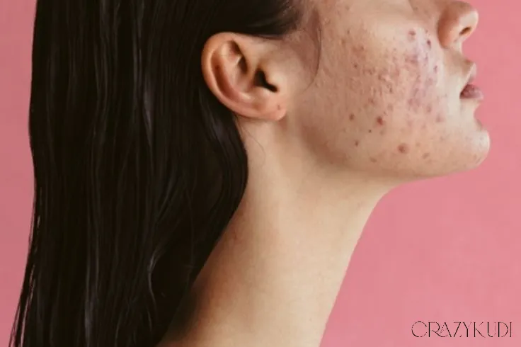 Minocycline: Is It an Effective Acne Treatment?
