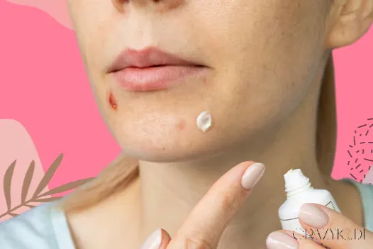 Can I Use Toothpaste on Pimples? A Dermatologist Explains Why You Should Think