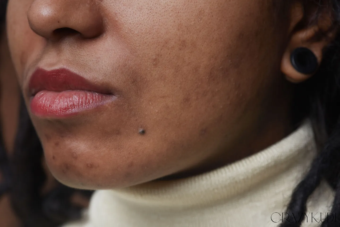 Acne Treatment Options for Black Skin: What Dermatologists Recommend