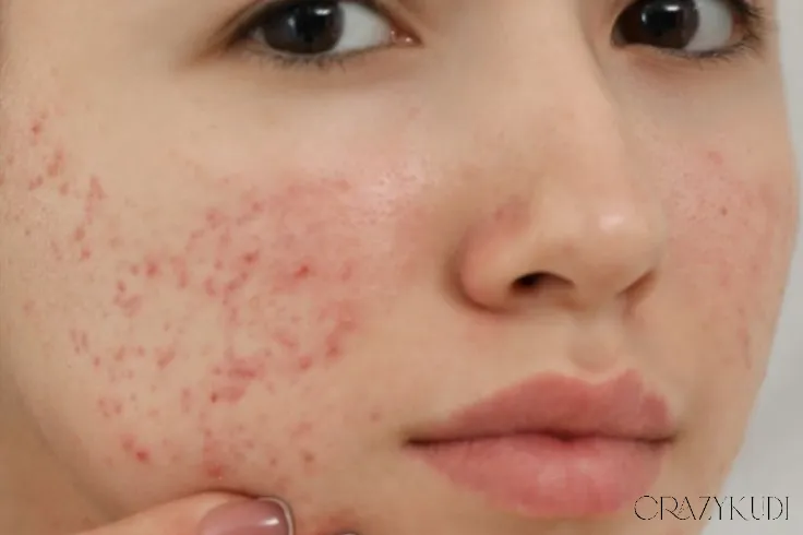 How to Treat Acne When You Have Dry Skin: A Dermatologist’s Guide