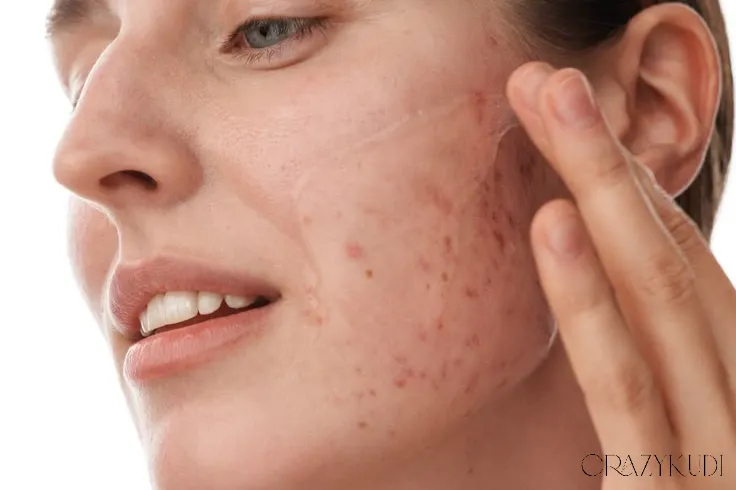 Which Facial Treatment Works Best for My Acne? A Dermatologist’s Guide