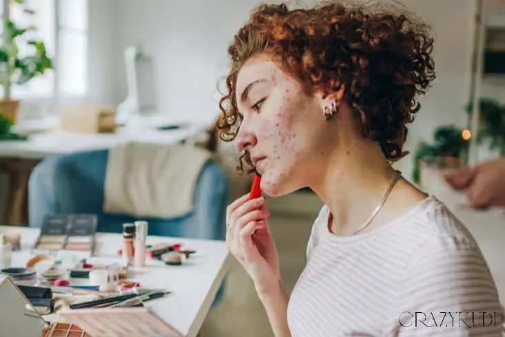 Adult Acne: Why Am I Still Breaking Out a Decade After Puberty?