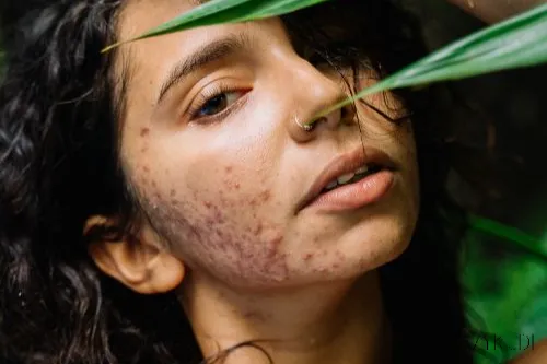 Acne and Diet Myths: A Dermatologist Sets the Record Straight on 5 Common Beliefs