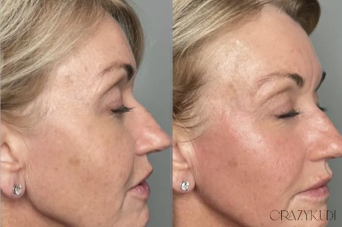Firming Up the Facts: A Dermatologist Explains Radiofrequency Skin Tightening