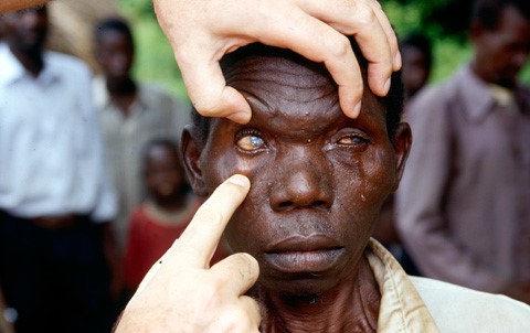 Niger Becomes First African Nation to Eliminate River Blindness – WHO