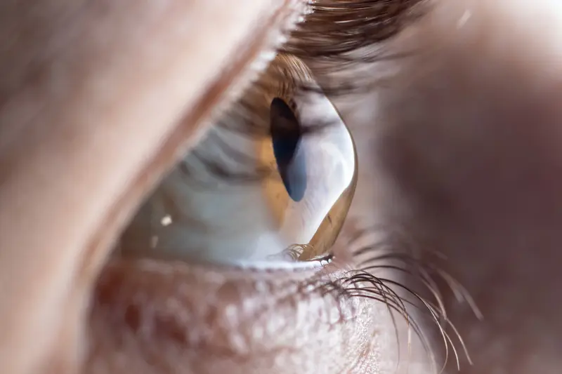 24 Million Nigerians Living With Sight Loss – DUFUHS VC