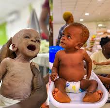 Lagos Lg Unveils Nutrition Programme To Tackle Child Malnutrition