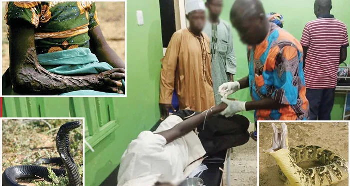 Snakebite Cases Drop For Third Year In Kaduna — Health Commissioner