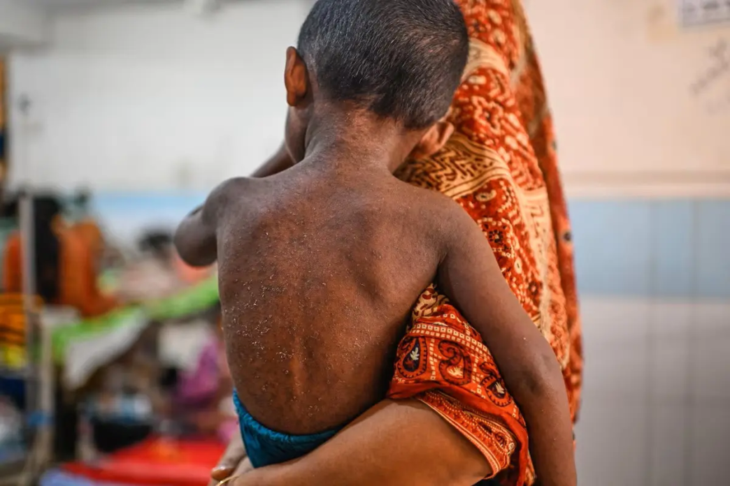 Bangladesh Measles Crisis Nears 1,000 Deaths as Hospitals Overwhelmed