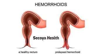 Dr. Schilling Discussed About Hemorrhoids 😩💩