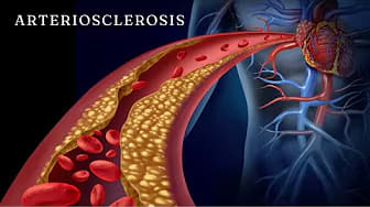 Explained by Dr. Daniel Schilling About Arteriosclerosis