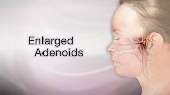 The Impact of Adenoid Inflammation on Health