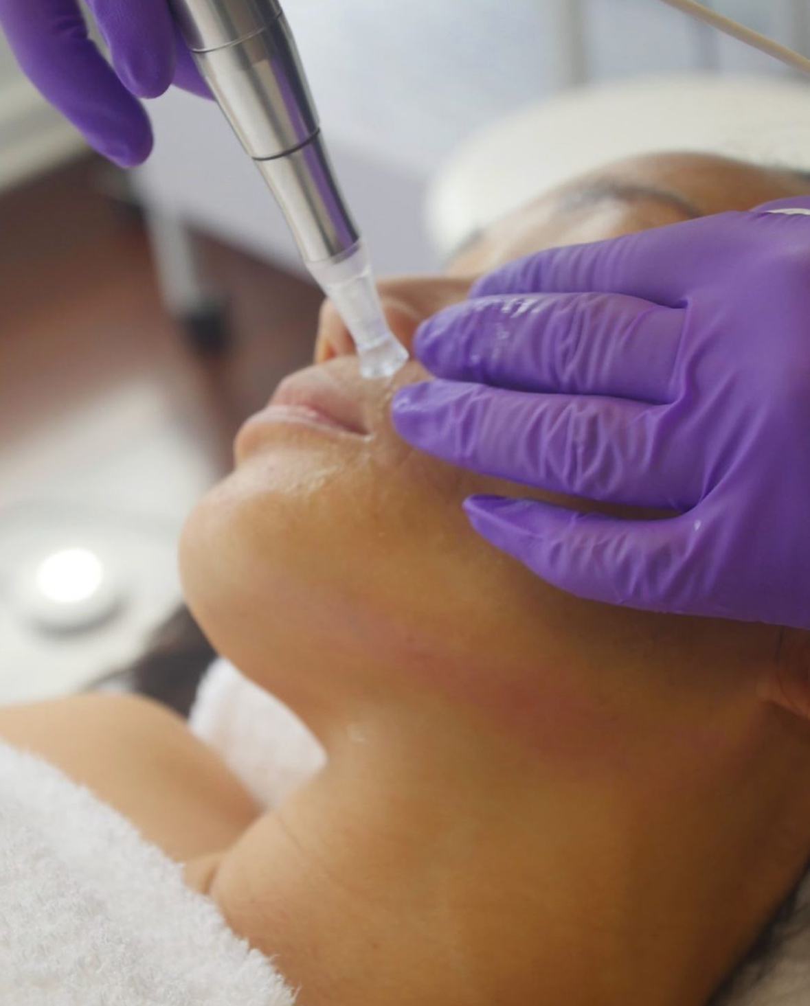 Microneedling