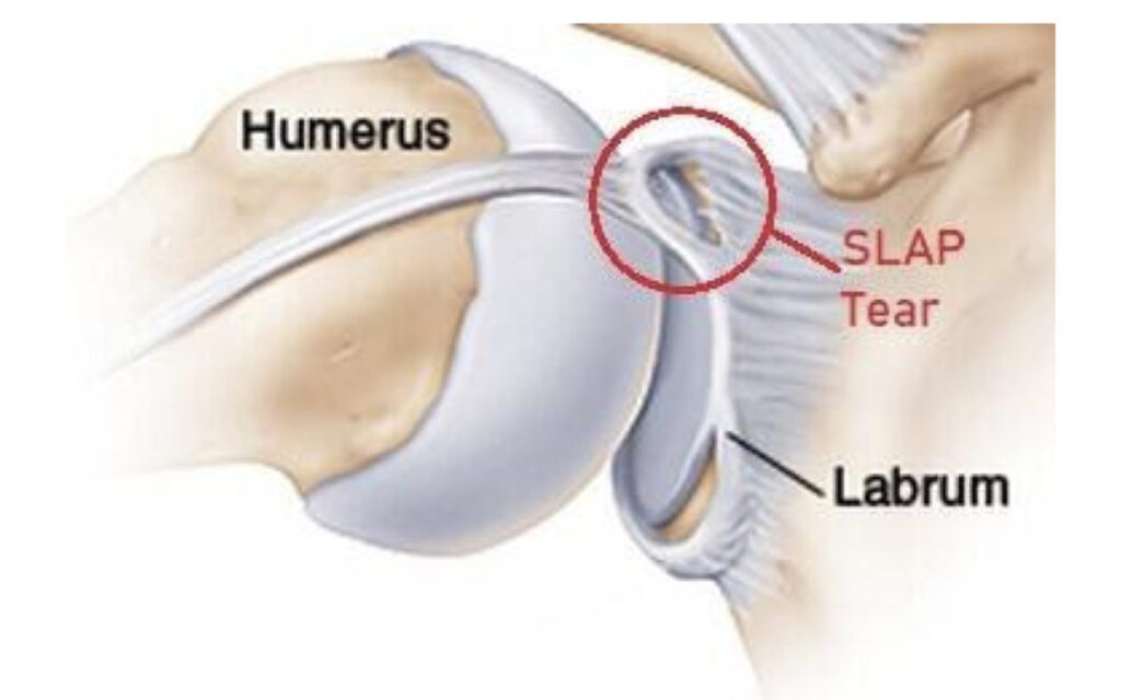 Labral tear in shoulder and hip joints