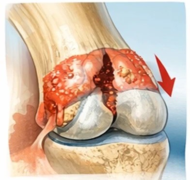 Ligament injury affecting joint stability