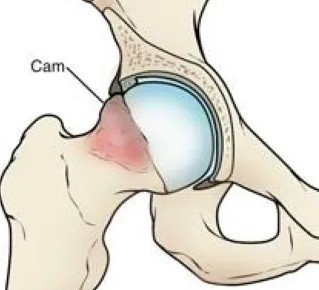 Diagram showing cam morphology at the femoral head–neck junction