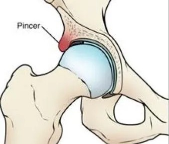 Diagram showing pincer morphology with increased acetabular coverage