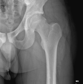 Generic hip X-ray image representing imaging used to assess hip morphology