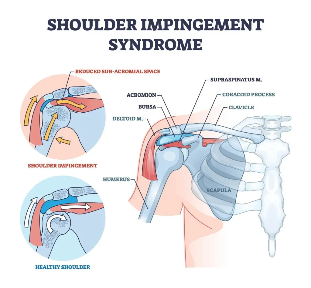 shoulder anatomy shows tendon impingement