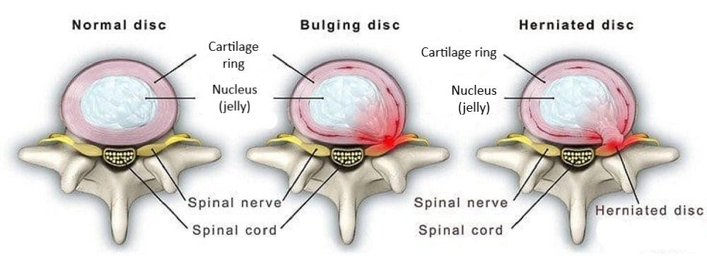 L4 L5 disc herniation comparison