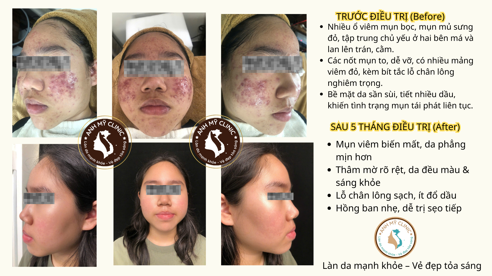 dieu-tri-mun-trung-ca-anh-my-clinic_k5nxmn.png Hiệu quả điều trị mụn trứng cá nặng sau 5 tháng