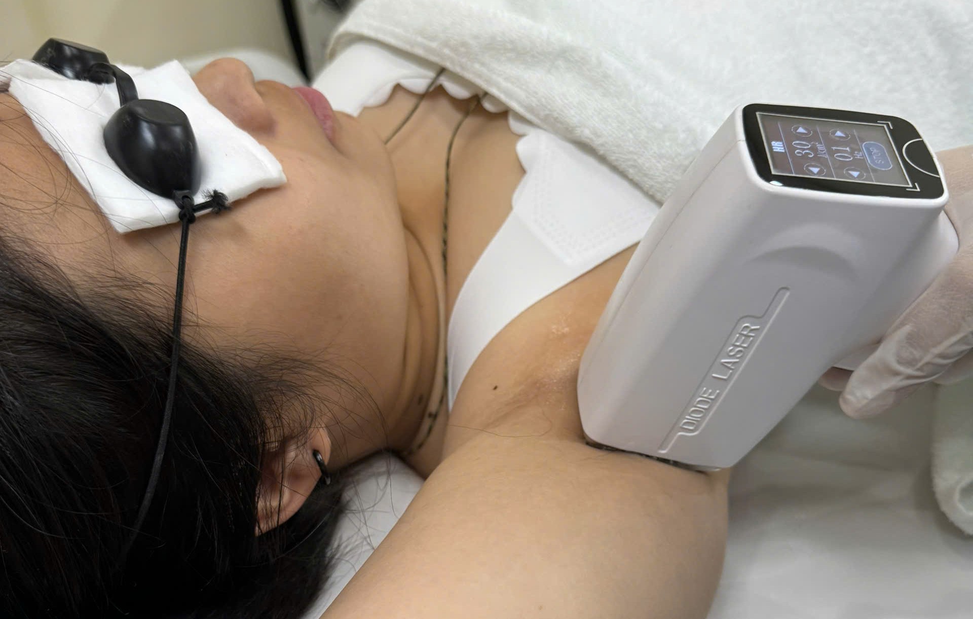 Laser diode triệt lông nách
