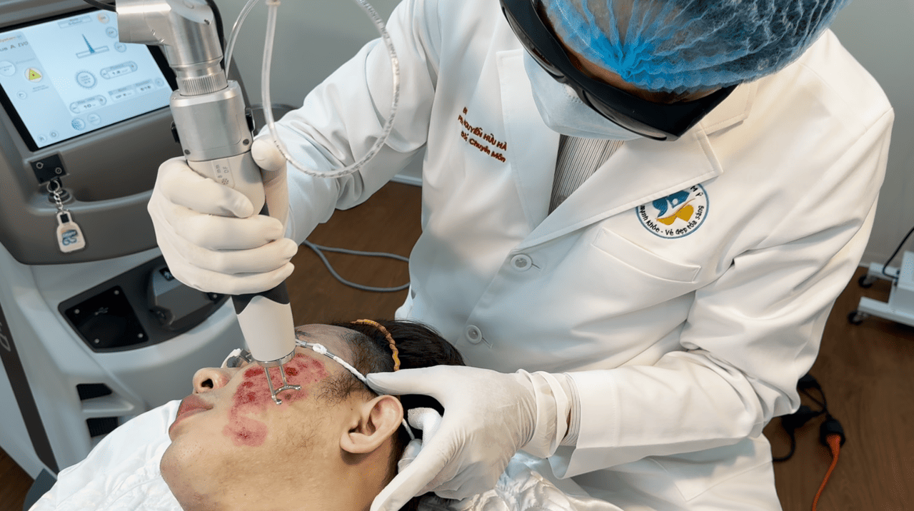 Laser Nd:Yag xóa sẹo rỗ