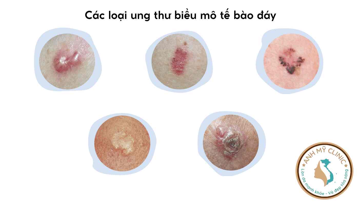 Các loại ung thư biểu mô tế bào đáy