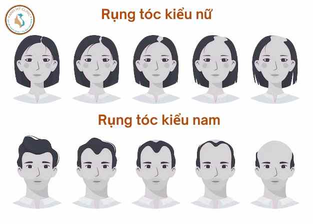 Rụng tóc androgen