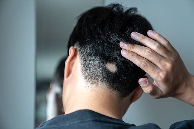 Rụng tóc từng vùng