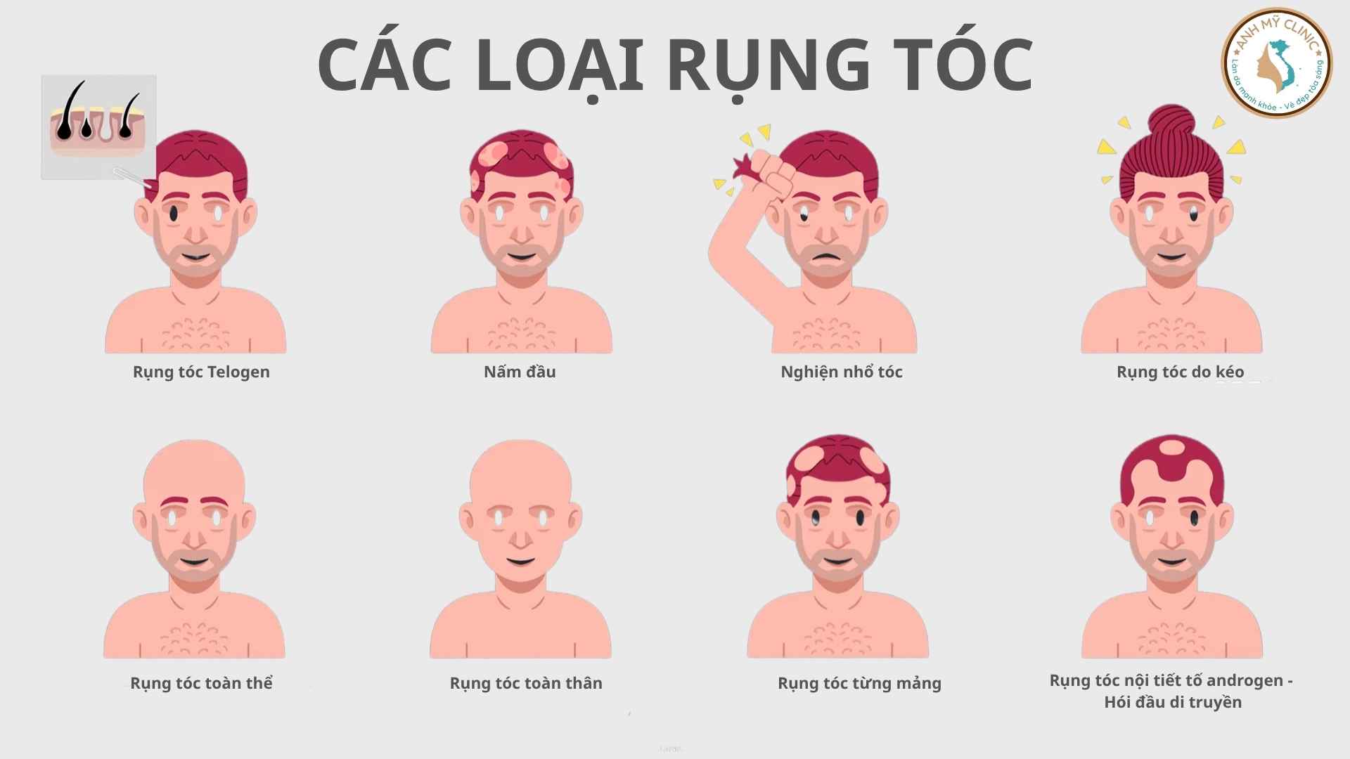 Các loại rụng tóc