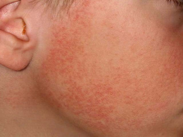 Dày sừng nang lông teo da ở mặt
