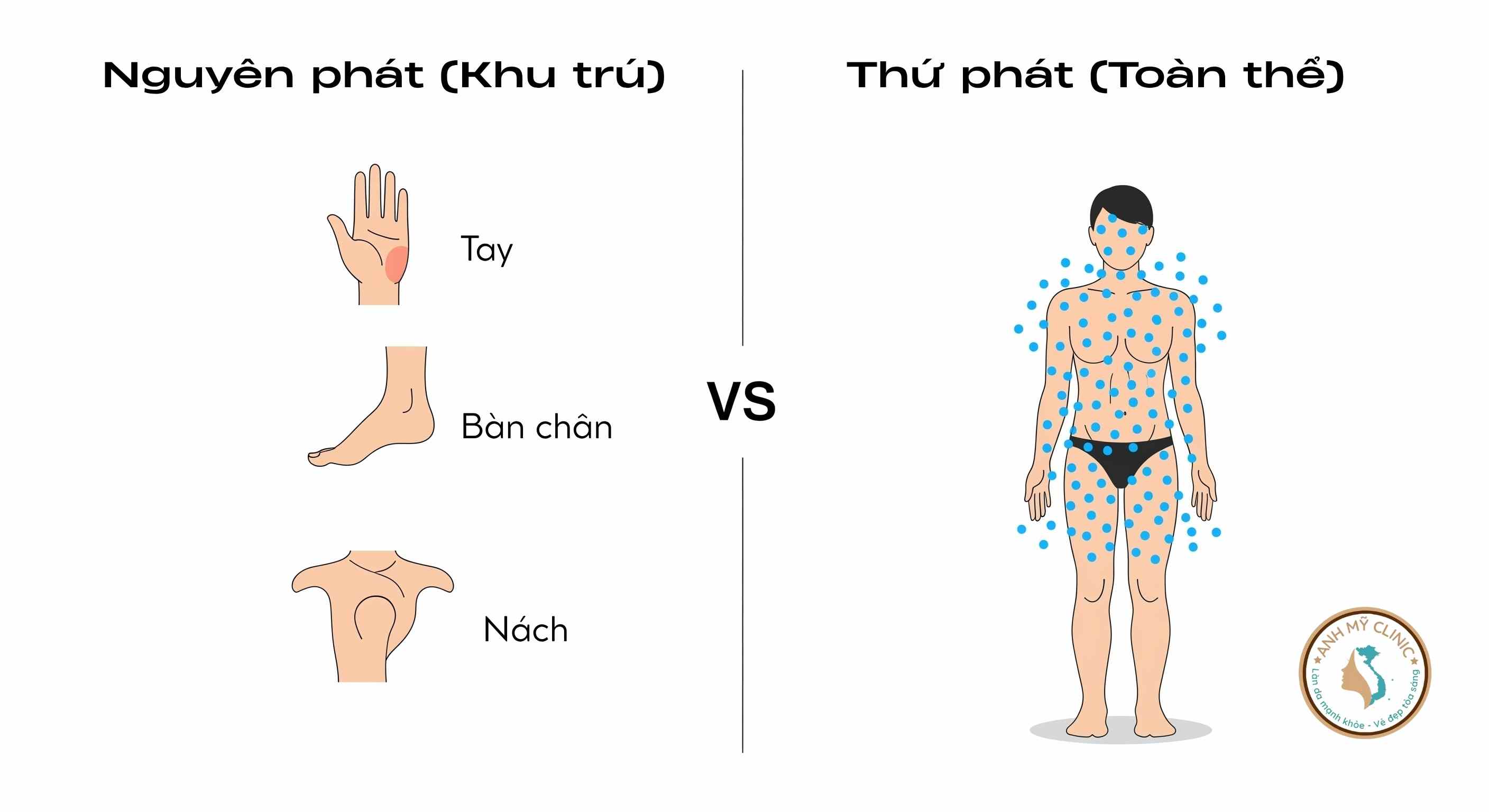 Phân loại tăng tiết mồ hôi