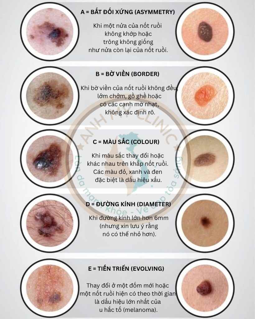 Phân biệt u lành da và u ác tính