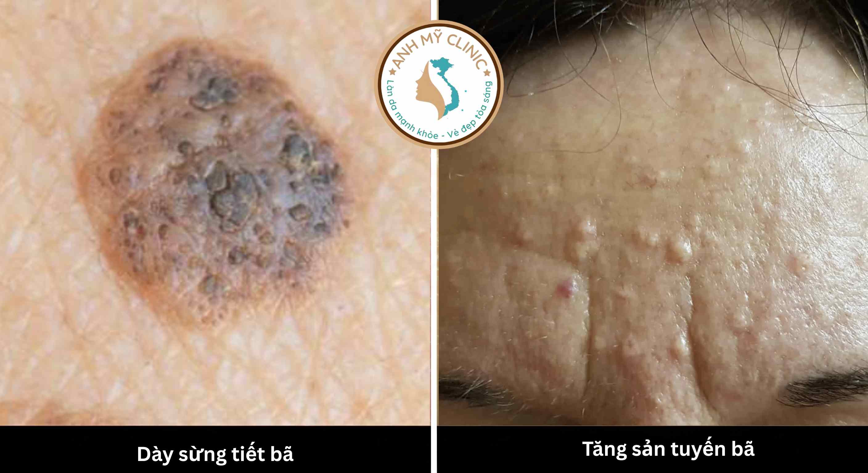 Soi da là công cụ không thể thiếu giúp bác sĩ phân biệt các tổn thương lành tính như dày sừng tiết bã và tăng sản tuyến bã với các dạng ung thư da. 
