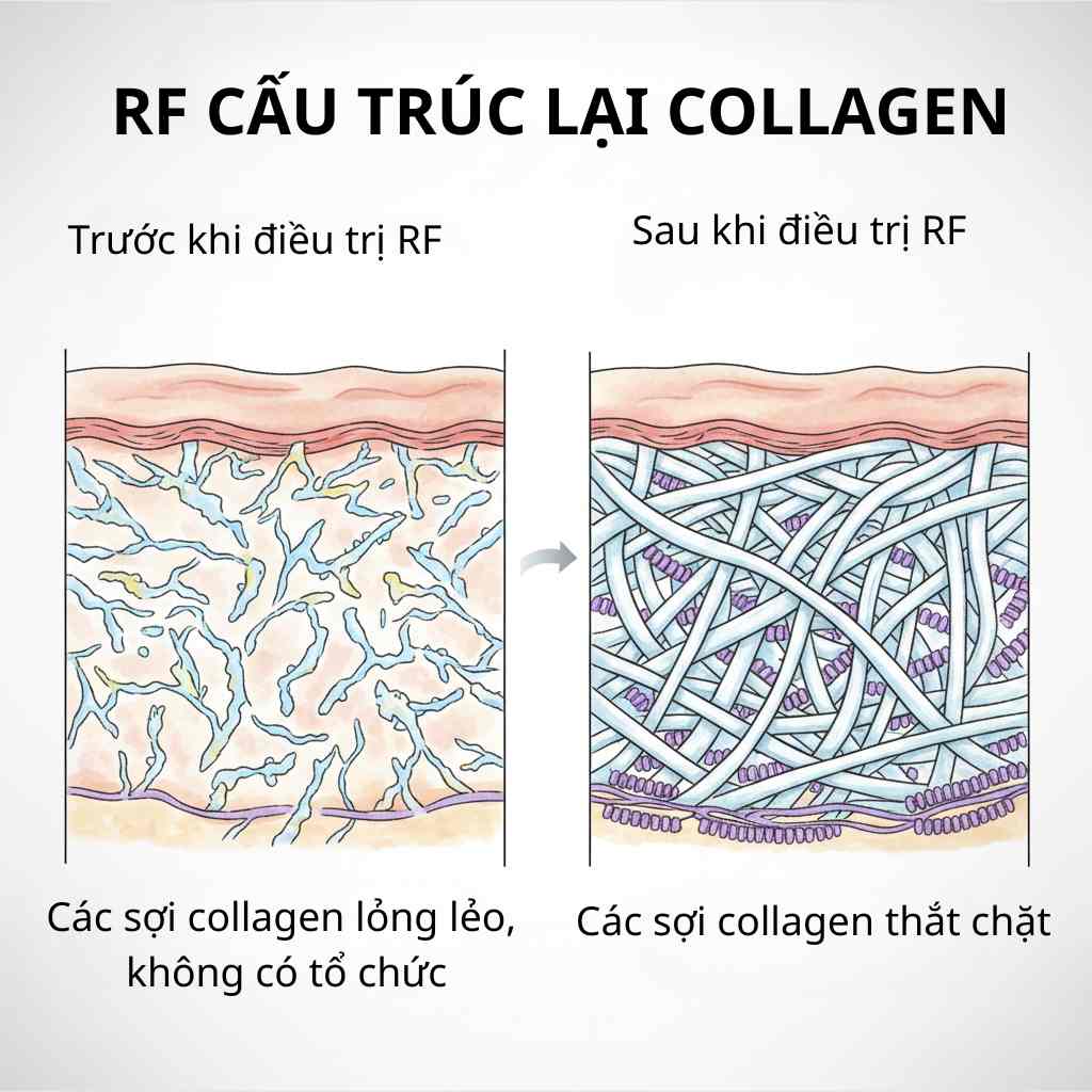 Cơ chế tác động kép của RF: vừa co rút collagen cũ, vừa kích thích tăng sinh collagen và elastin mới để trẻ hóa da bền vững.