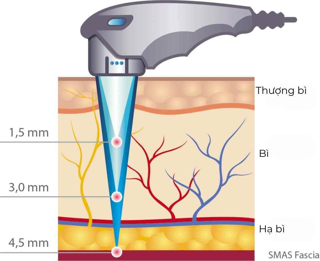 co-che-tac-dong-hifu-nang-co_ruwhbt.jpg Hình ảnh mô tả cơ chế sóng siêu âm của công nghệ HIFU tác động chính xác vào lớp SMAS, giúp nâng cơ vùng mặt và nọng cằm từ sâu bên trong.