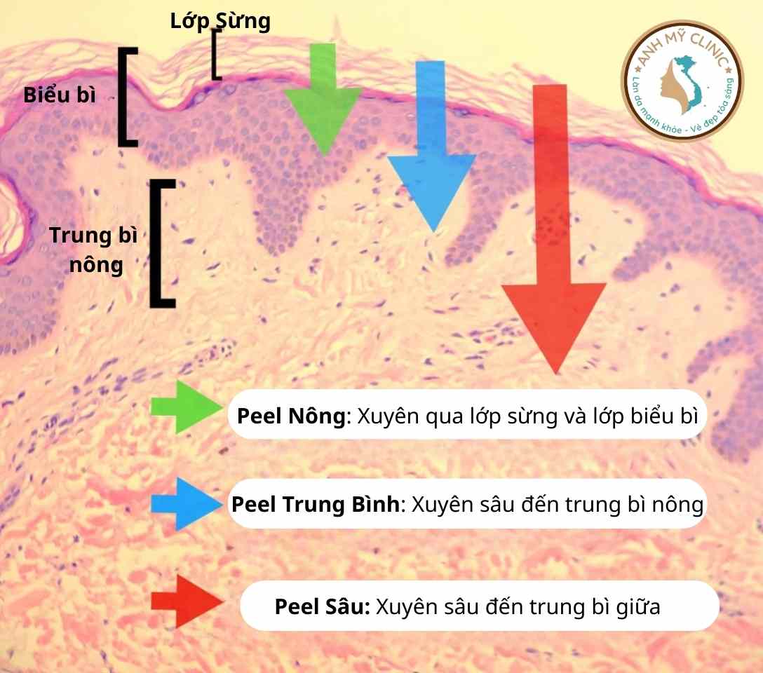 Phân biệt 3 cấp độ peel da hóa học và ứng dụng tương ứng.