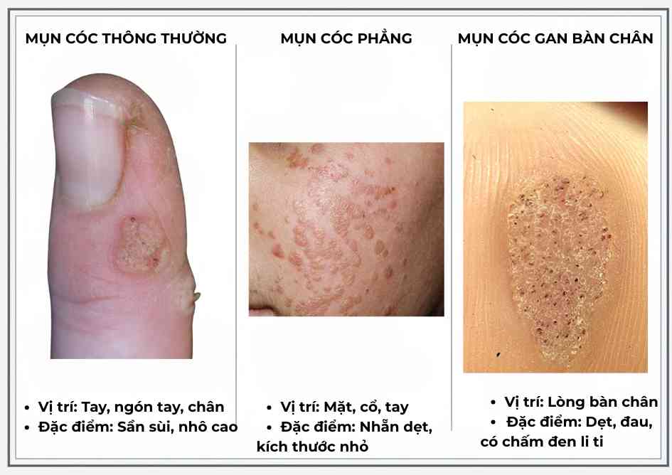 So sánh hình ảnh mụn cóc thông thường, mụn cóc phẳng, mụn cóc bàn chân
