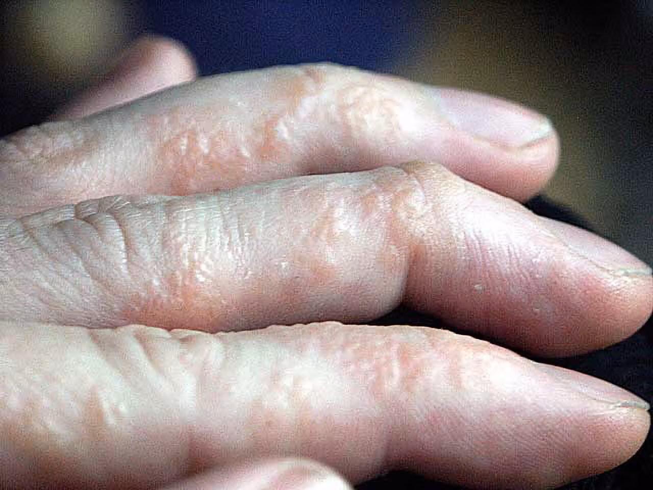 Bàn tay bị chàm tổ đỉa với nhiều mụn nước nhỏ, li ti.
